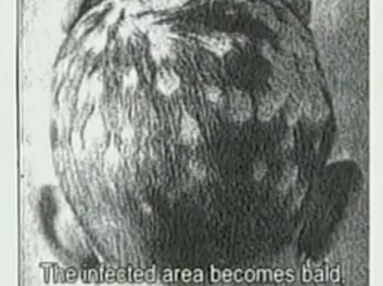 [Video] “The Ringworm Children”, documentario (premiato): l’esperimento israeliano su 100.000 bambini ebrei sefarditi