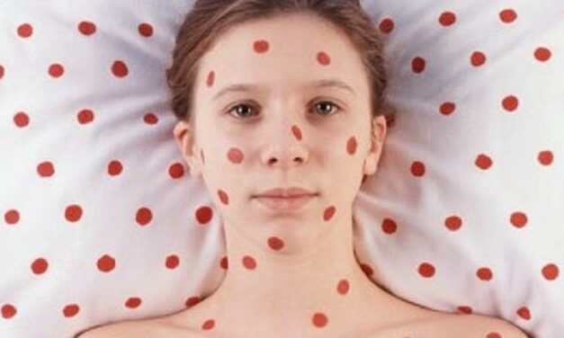 [VACCILEAKS] Poco morbillo e tante, tante parole.