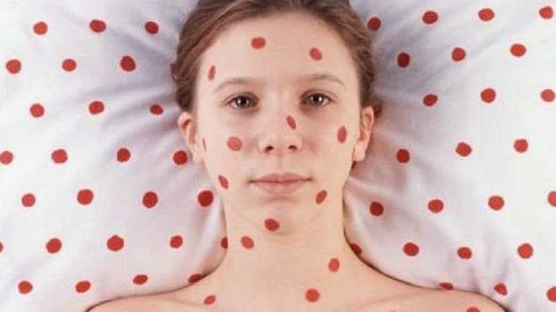 [VACCILEAKS] Poco morbillo e tante, tante parole.